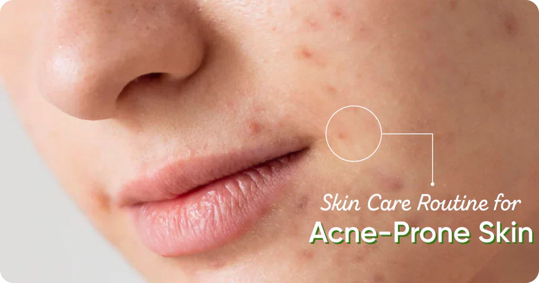 Rice Water for Acne-Prone Skin: Why This K-Beauty Secret Actually Works